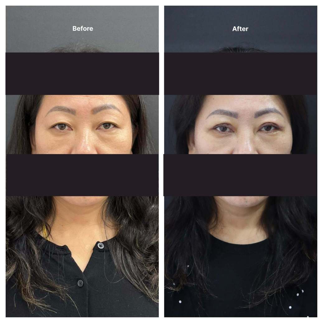 Eyelid Surgery KOQ10